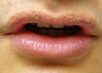 What is Fordyce Spots? | Causes & Treatment  of Fordyce Spots