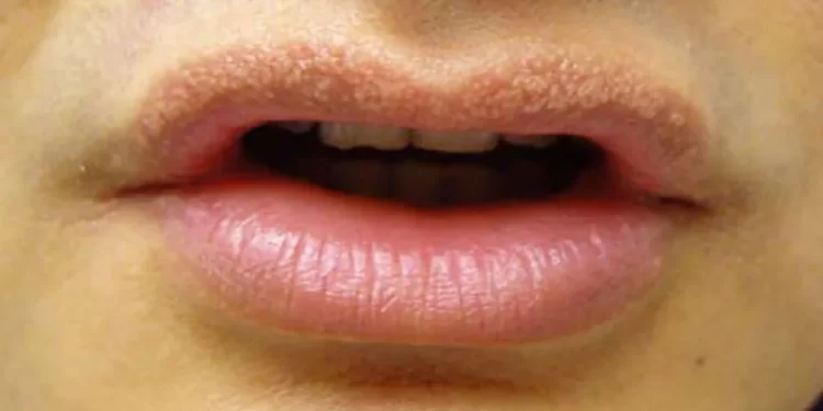 What is Fordyce Spots? | Causes & Treatment  of Fordyce Spots